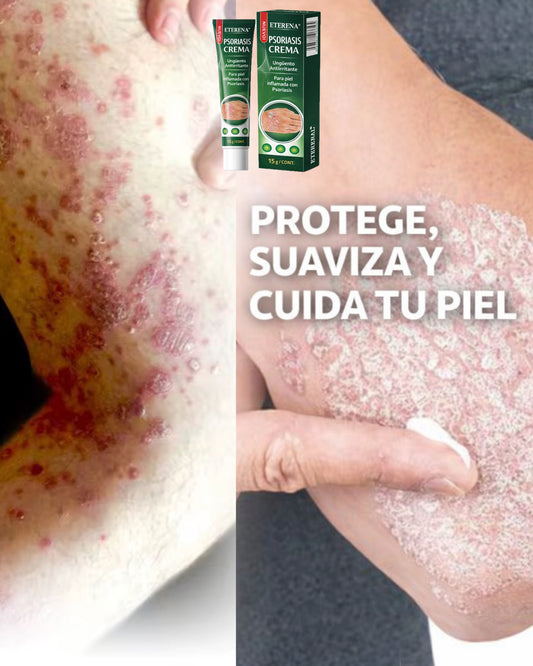 Psoriasis Cream – Crema para Psoriasis